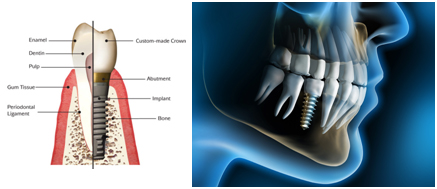 Implantes