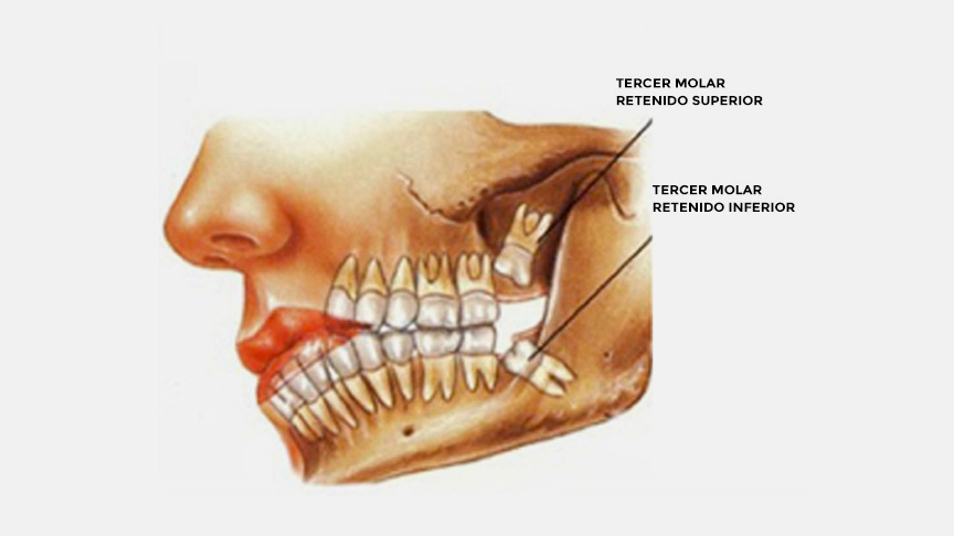 Terceros molares incluidos