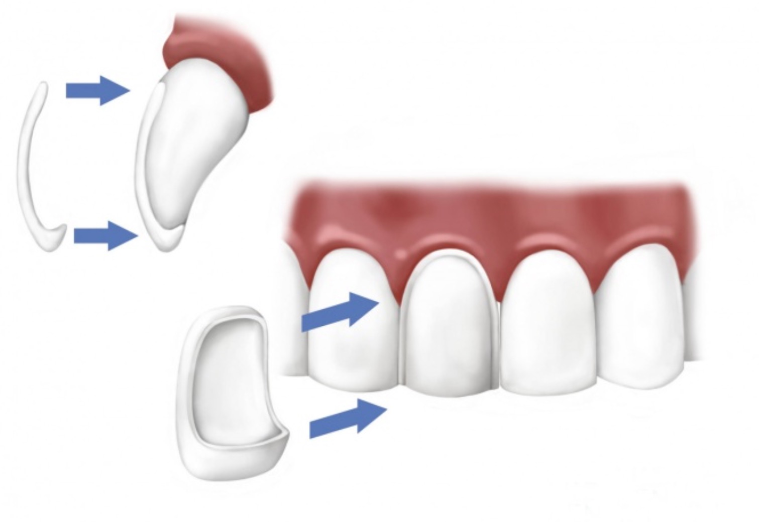 Estetica dental carillas